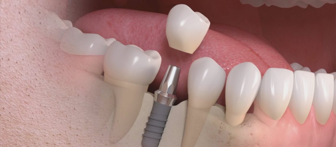 foto implantes de la sección Tratamientos